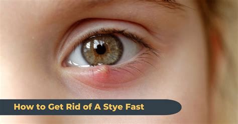 How to Get Rid of a Stye in 7 Days or Less