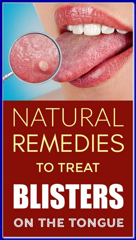 How to Heal Blisters in Mouth: 10 Proven Methods