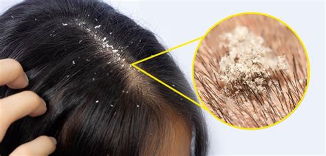 How to Prevent Dandruff and Itchy Scalp: 5,000+ Proven Methods