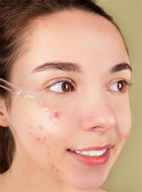 How to Remove Dark Spots Caused by Pimples: 10 Proven Methods