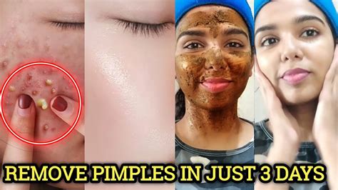 How to Remove Pimple Scars Overnight: 20 Proven Methods Tonight