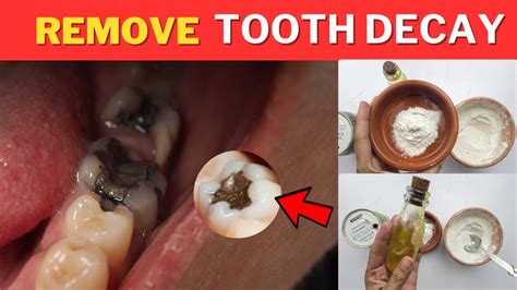 How to Remove Tooth Decay Yourself: 5 Proven Methods