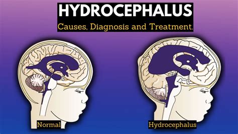 Hydrocephalus Pathogenesis and Treatment Doc