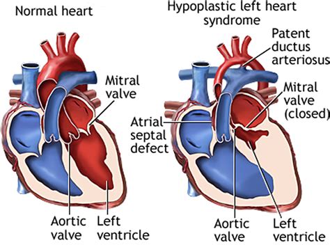 Hypoplastic Left Heart Syndrome Epub