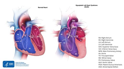 Hypoplastic Left Heart Syndrome 1st Edition Doc