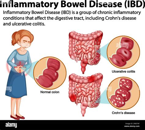 IBDQ: The Essential Tool for Monitoring Inflammatory Bowel Disease