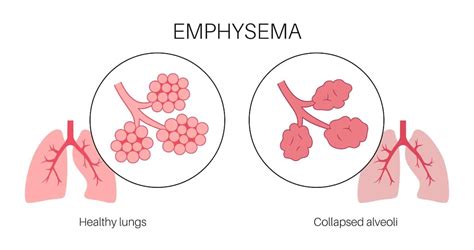 ICD-10 Centrilobular Emphysema: A Comprehensive Guide