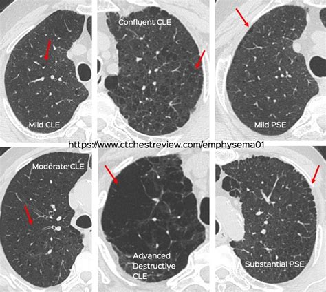 ICD-10 Centrilobular Emphysema: Delving into the Nuances of Lung Disease