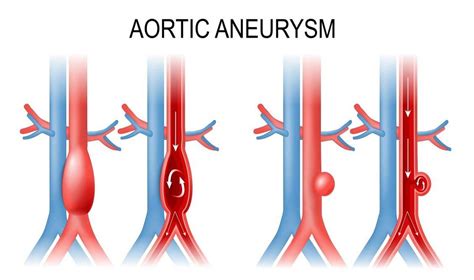 ICD-10 Code for Ascending Aortic Aneurysm: I25.0