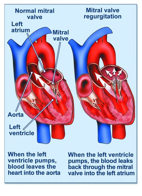 ICD-10 for Mitral Valve Regurgitation: A Comprehensive Guide (I06)