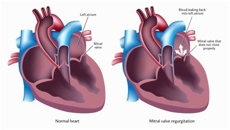 ICD-10 for Mitral Valve Regurgitation: Your 2025 Guide