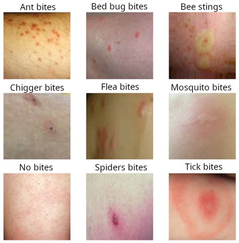 Identifying Flea Bites