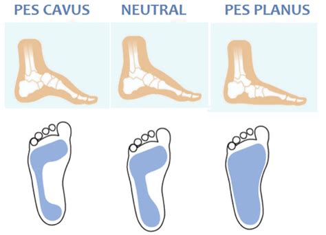 Ignoring Foot Type: