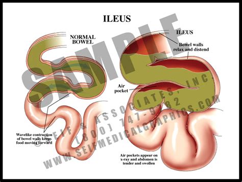 Ileus A Medical Dictionary Epub