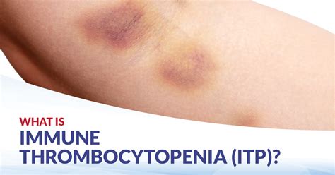 Immune Thrombocytopenia (ITP):