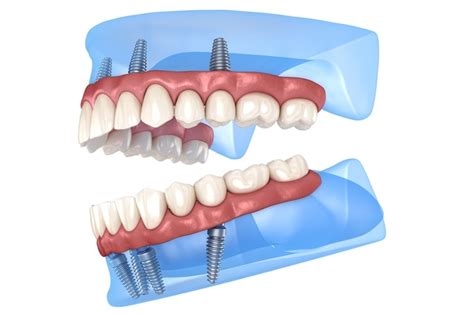 Implant Dentistry in New York: Your Guide to the Latest Innovations