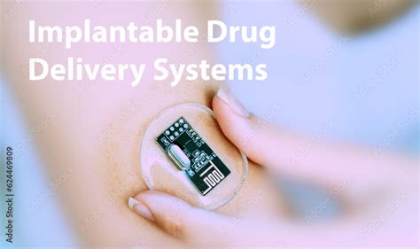 Implantable Drug Delivery System: