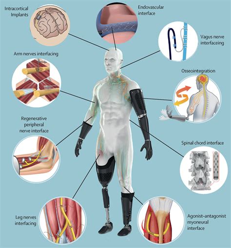 Implantable Neural Prostheses 1 Devices and Applications PDF