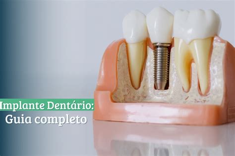 Implante Dentário: Um Guia Completo