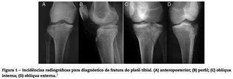 Importância do Plato Tibial