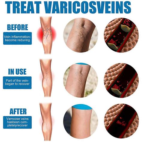 Improves Vein Function: