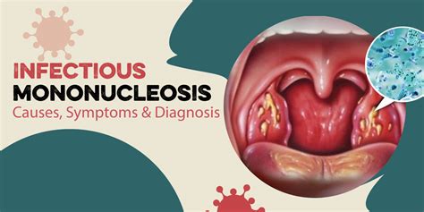 Infectious Mononucleosis Doc