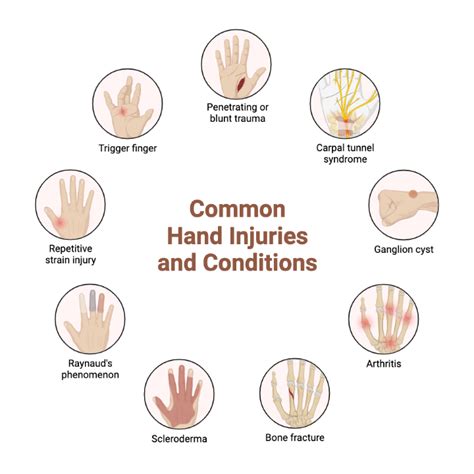 Injuries of Hand PDF