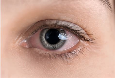 Inner Corner of Eye Swollen: 7 Causes, 3 Common Mistakes, and 4 Treatments