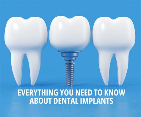 Insurance for Dental Implants: Everything You Need to Know