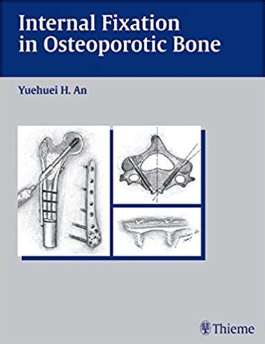 Internal Fixation in Osteoporotic Bone 1st Edition Kindle Editon