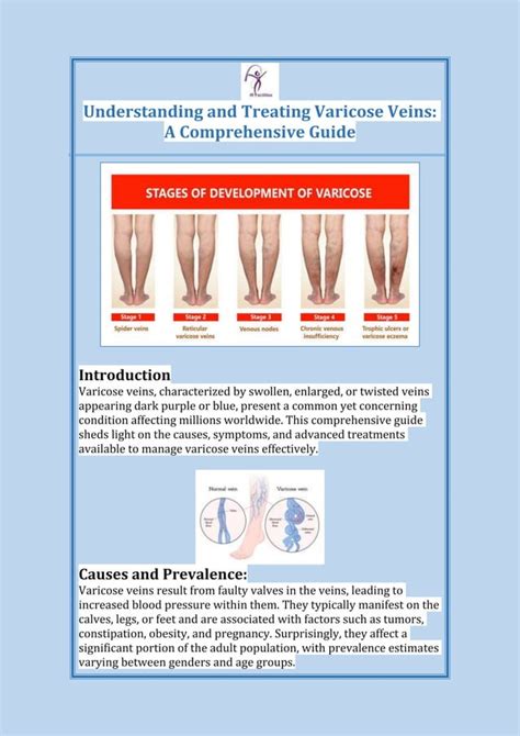 Interveined: A Comprehensive Guide to Understanding and Managing Varicose Veins