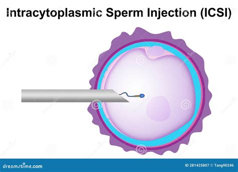 Intracytoplasmic Sperm Injection (ICSI)