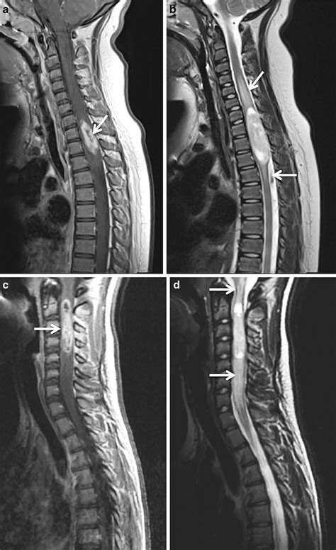 Intramedullary Spinal Cord Tumors Reader