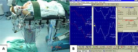 Intraoperative Neuromonitoring Tech: A Guardian for the Nervous System During Surgery