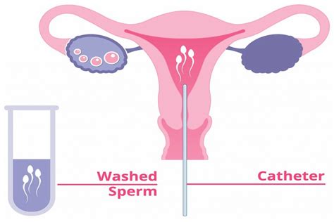 Intrauterine Insemination (IUI)