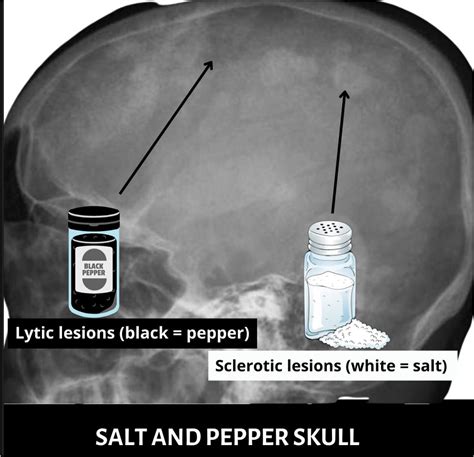 Introduction: The Allure of the Salt Pepper Skull