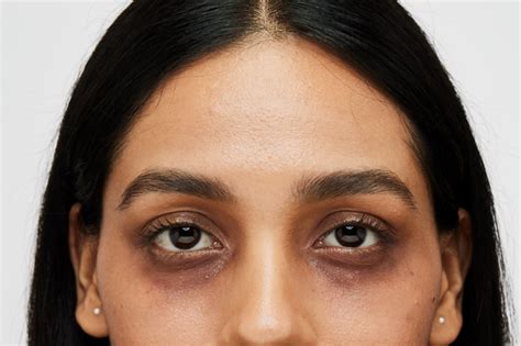 Introduction: The Dark Truth About Dark Circles