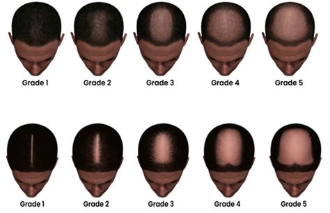 Introduction: The Growing Problem of Thinning Hair in Men