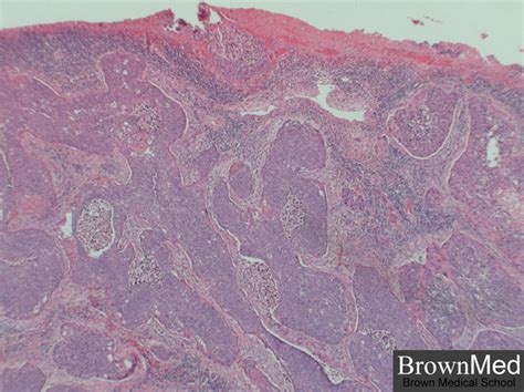 Invasive Carcinoma of the Cervix Doc