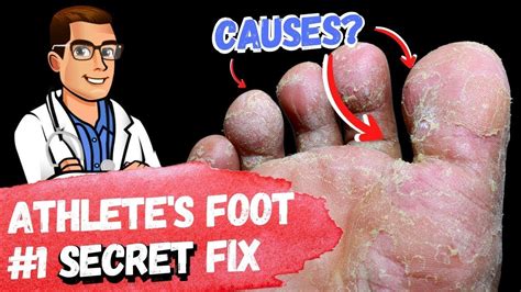 Is Athlete's Foot Contagious to Others: 23,000,000 Americans Can't Be Wrong