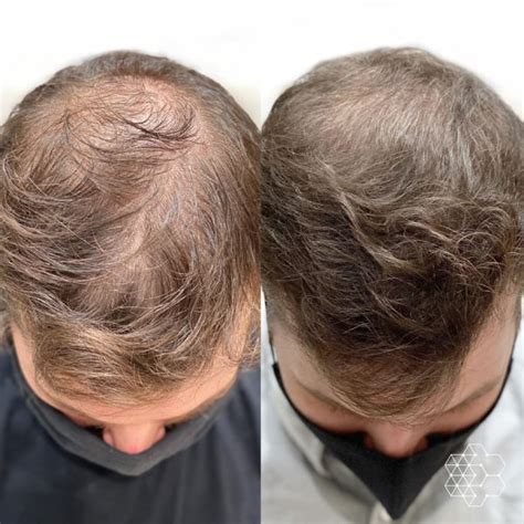 It is a non-invasive and affordable alternative to hair transplants and medications.