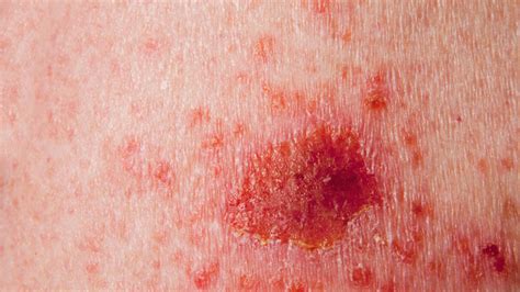 Itching Skin Cancer: Recognizing and Treating an Insidious Threat