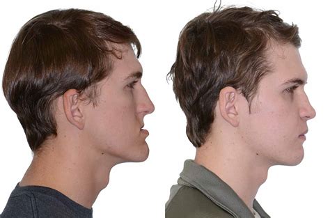 Jaw Surgery: