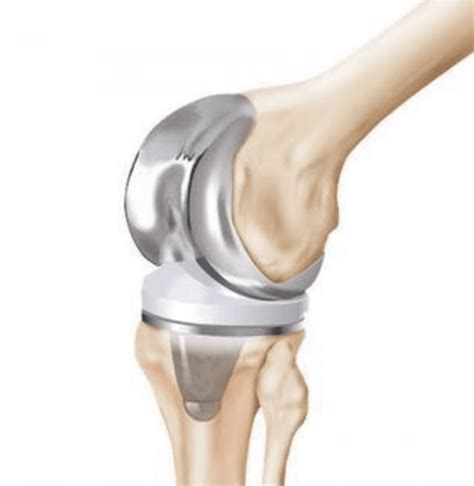 Joint Replacement: