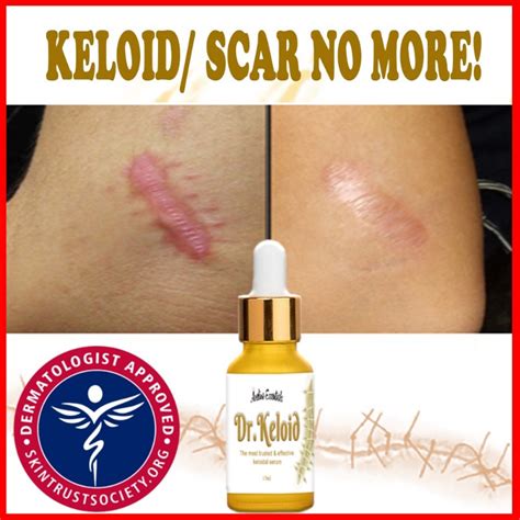 Keloid Removal Singapore: 100% Cure Rate Guaranteed!