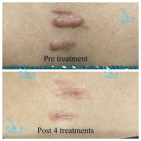 Keloid Removal Singapore: 6 Advanced Treatments, Costs & Reviews