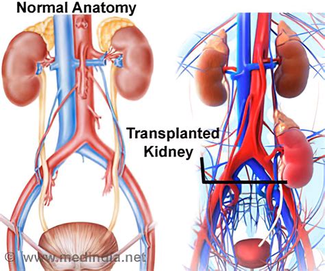 Kidney Transplantation Doc