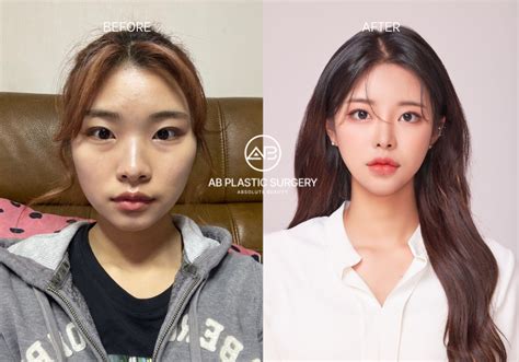 Korean Plastic Surgery: Before and After: Drastic Transformations in 2025