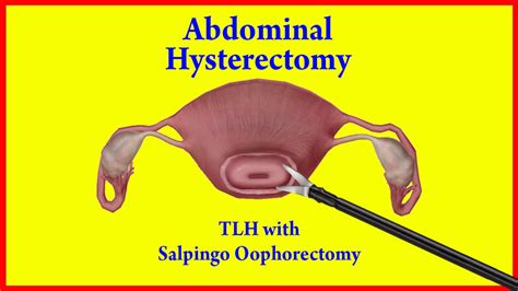 Laparoscopic Hysterectomy and Oophorectomy A Practical Manual and Colour Atlas Kindle Editon