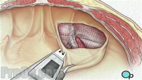 Laparoscopic Inguinal Hernia Repair Doc